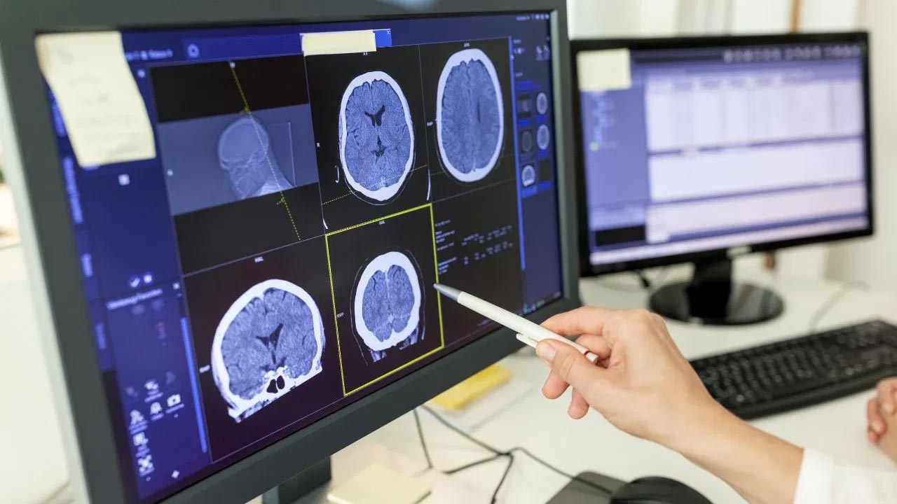 Brain Stroke: Who is at risk of brain stroke?