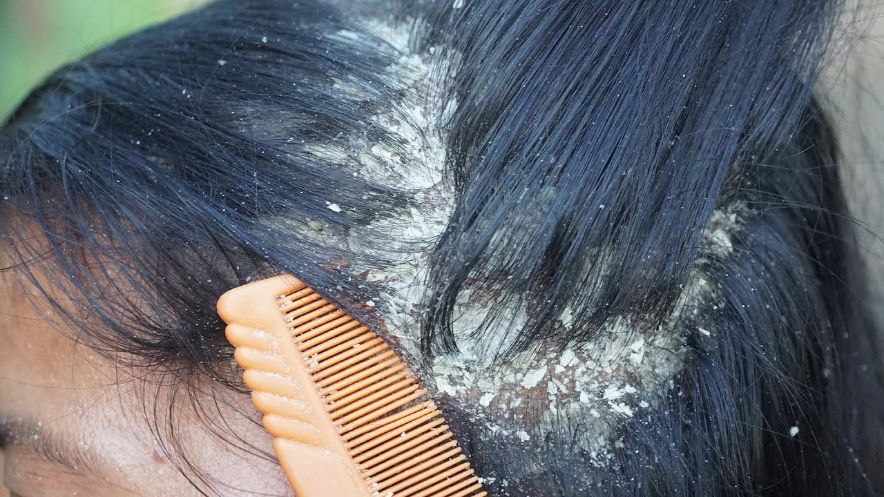 Dandruff Causes: Why does dandruff occur..? How to reduce..